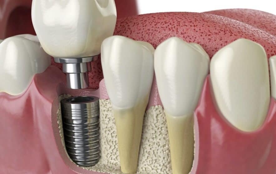 Implant Dentistry Peachtree City GA