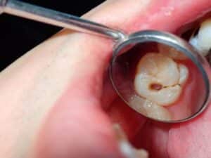 Tooth decay or cavity in the tooth