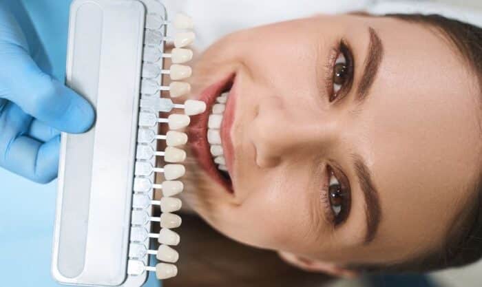 Dental Veneers