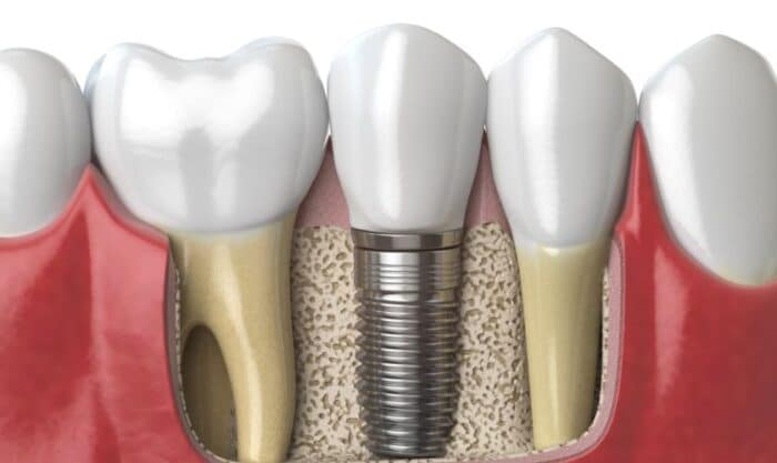 Dental Implants Peachtree City