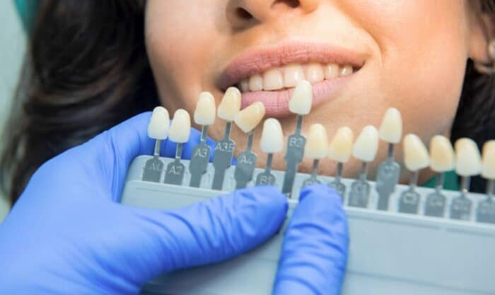 Dentist in blue gloves holding tooth shade guide against patient's teeth for color matching.