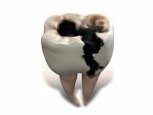 Dental Cavity