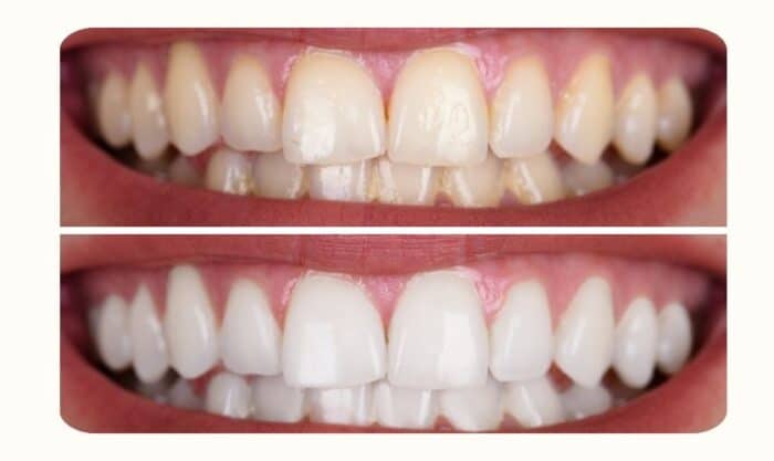 teeth whitening treatment peachtree city