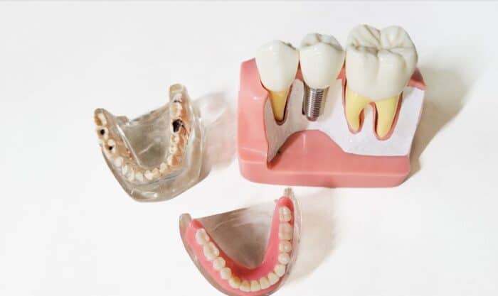 dental implants