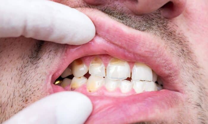 A man showing his teeth and enamel erosion is visible