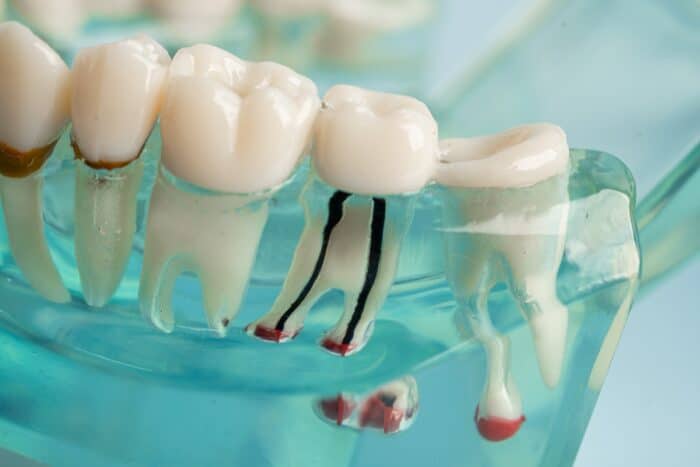 root-canal-in-Peachtree-city