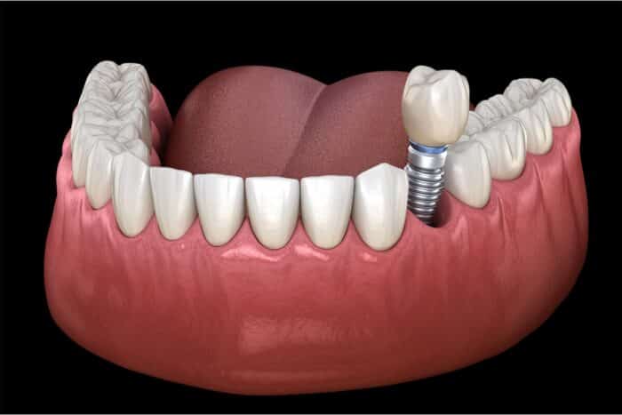 dental implants Peachtree City GA